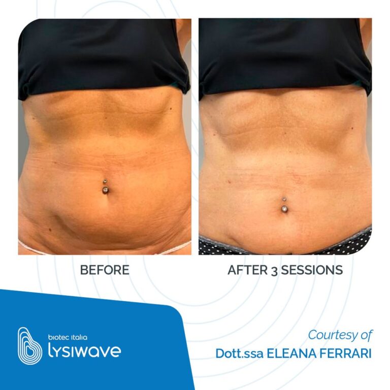 Antes y después de Lysiwave en abdomen, 3 sesiones