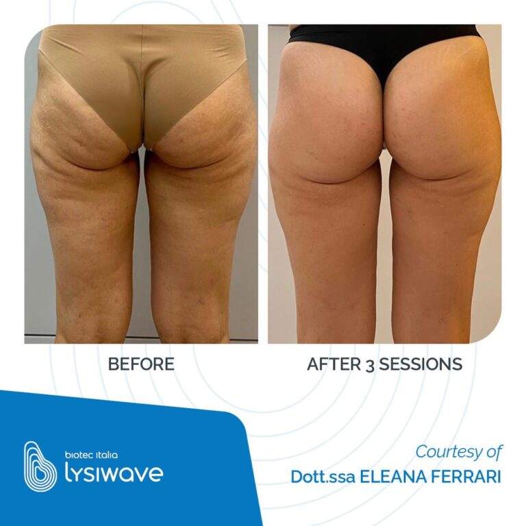 Antes y después de Lysiwave en celulitis de muslos, 3 sesiones