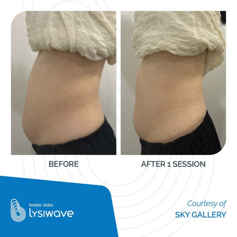 Antes y después de Lysiwave en abdomen, 1 sesión