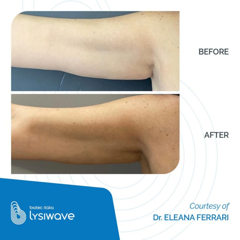 Antes y después de Lysiwave en flacidez del brazo