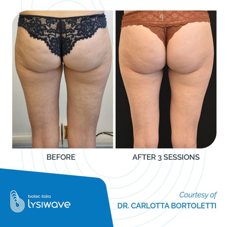 Antes y después de Lysiwave en celulitis de glúteos, 3 sesiones