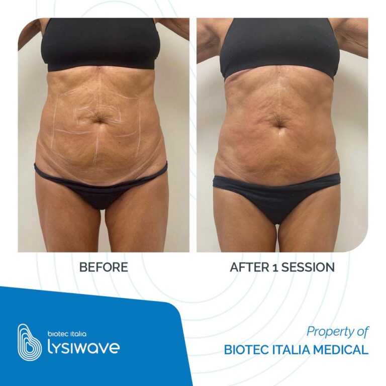 Antes y después de Lysiwave en abdomen, 1 sesión